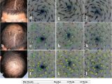 Max Wax for Hair Samples Of Resume Objectives Safety and Efficacy Of Alrv5xr In Men with androgenetic Alopecia …