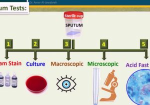 Process Sputum Samples In Lab Resume Sputum Culture-when to Reject Sample?